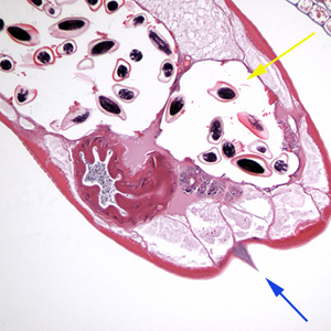 Cross section of an adult female E. vermicularis stained with H&E, recovered during a colonoscopy. Note the prominent alae (blue arrow) and the presence of eggs (yellow arrow). Image contributed by Sheboygan Memorial Hospital, Wisconsin. Adapted from CDC