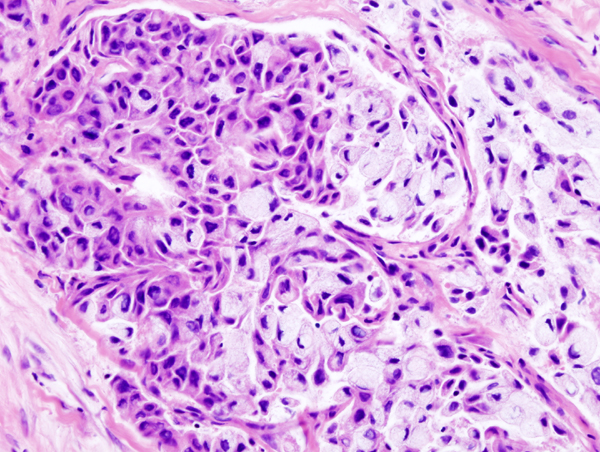 Histopathologic image of mucoepidermoid carcinoma of the major salivary gland. H & E stain.[1]