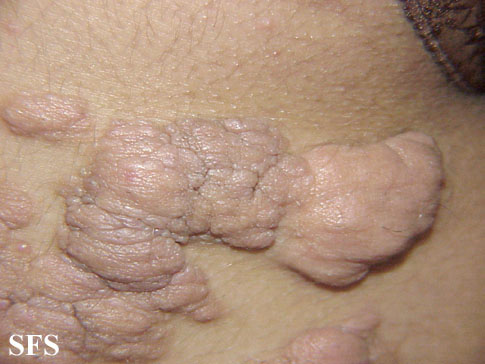 List of cutaneous conditions - Wikipedia