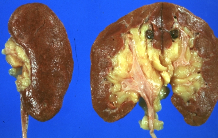 Kidney: Lupus Erythematosus: Gross natural color nice external and cut surface view of uniformly scarred and moderately shrunken kidneys