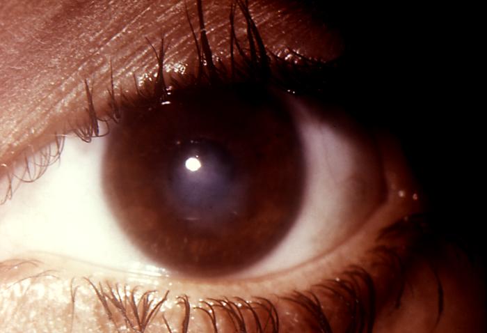 Note the cloudiness of this patient's right eye in this case of gonococcal conjunctivitis due to N. gonorrhoeae bacteria. Gonococcal conjunctivitis in caused by a direct inoculation of the conjunctival membrane of the eye with Neisseria gonorrhoeae bacteria, causing this membrane covering the eye to become inflamed, edematous, and produce a purulent exudate. Adapted from CDC