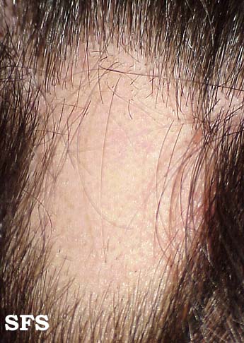 File:Alopecia areata 06.jpeg