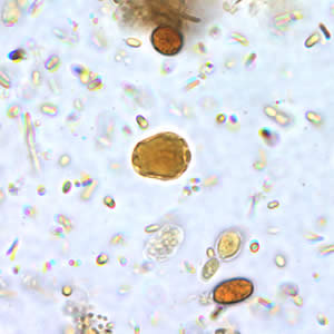 B. hominis cyst-like forms in wet mounts stained in iodine. Adapted from CDC