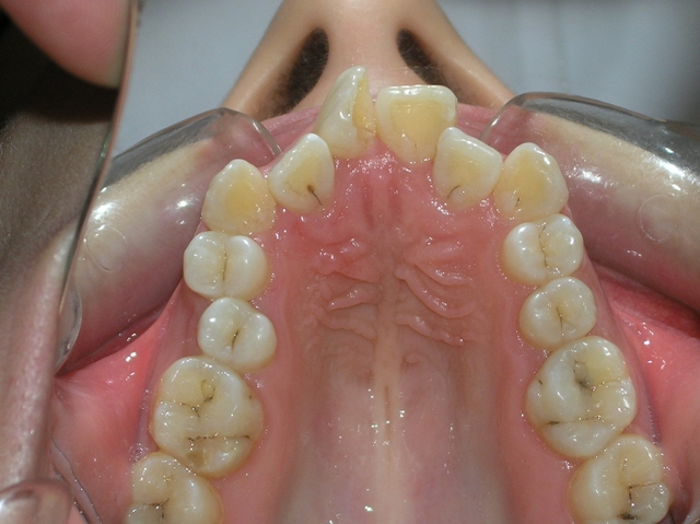 Before Orthodontic treatment (Intraoral view)