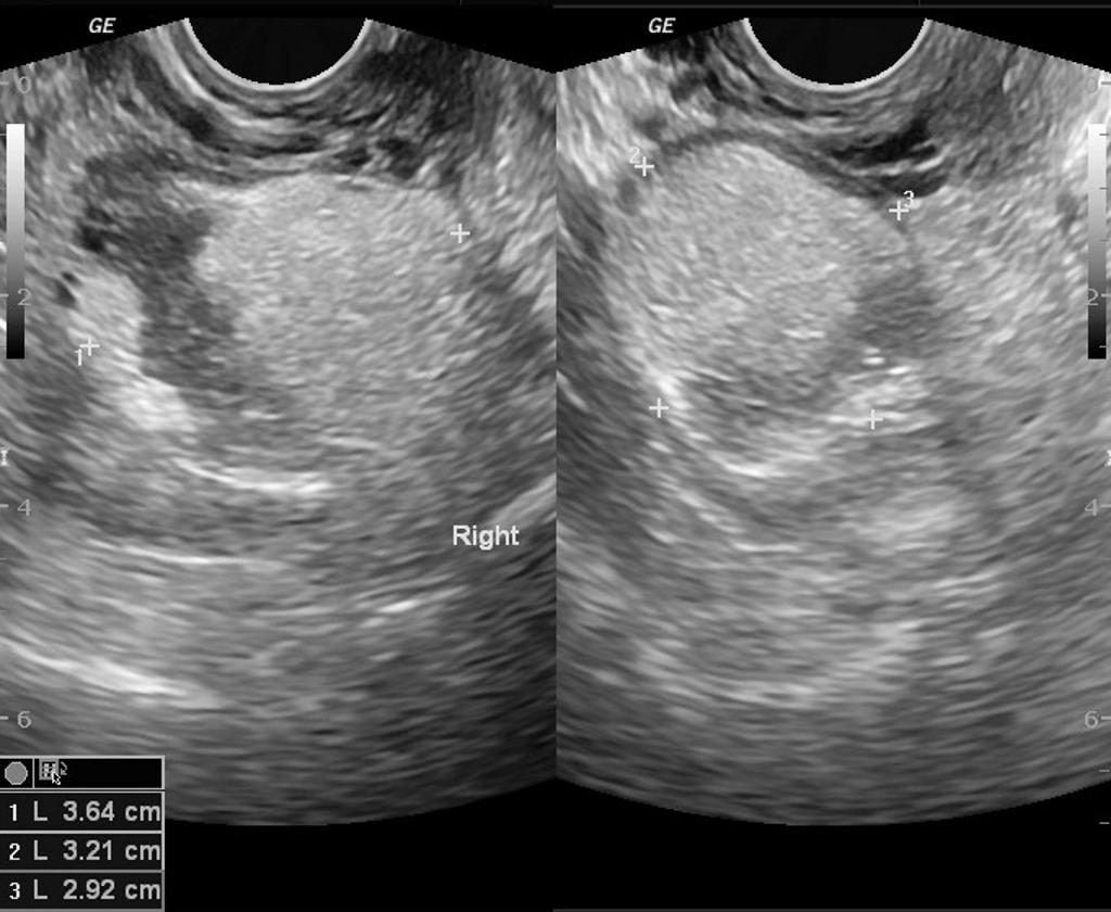 File:Ovarian-dermoid-4.jpg