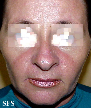 Systemic lupus erythematosus. Adapted from Dermatology Atlas.[4]