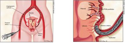 File:Uterine artery embolization 1.jpg