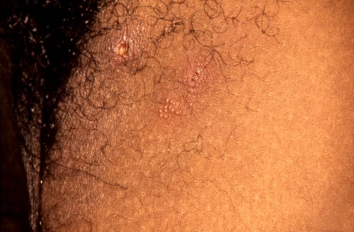 This patient presented with what were recurrent characteristic vesiculopapular herpes simplex lesions on his anterior thigh. These early vesiculopapular herpetic lesions on the anterior thigh (Cntr) had yet to rupture. Herpes simplex virus is a member of a group of viruses including those which cause oral herpes (usually HSV-1), and genital herpes (usually HSV-2). Adapted from CDC