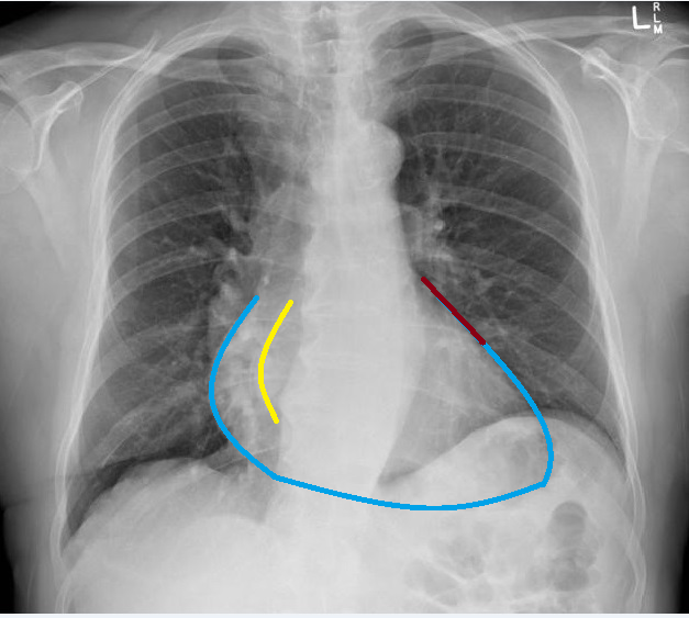 File:Chest X ray of mitral stenosis with borders.bmp