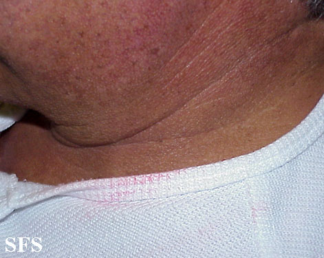 Chromhidrosis. Adapted from Dermatology Atlas.[1]
