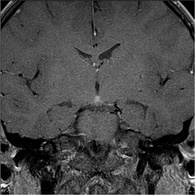 Coronal T1 C+ MRI of germinoma of third ventricle[7]