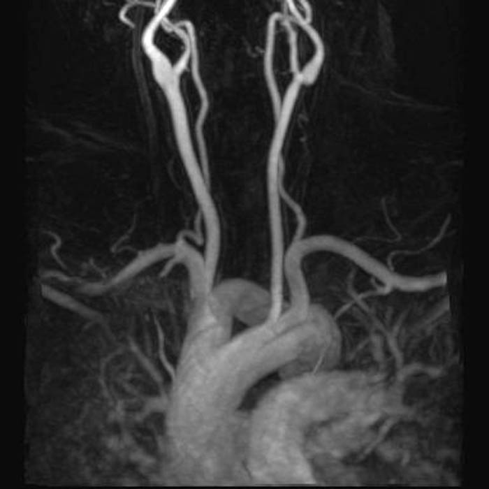 File:Double aortic arch MRI 001.jpg