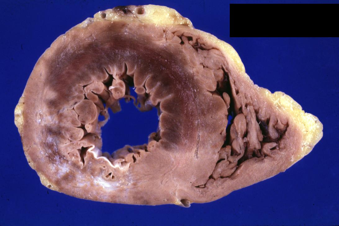 Gross example of acute infarction in fixed heart. Lesion is reflow necrosis stone heart also has old scar