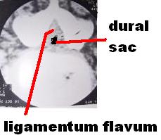 File:Spinal stenosis 1.JPG