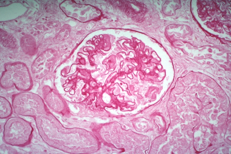 Kidney: Lupus Erythematosus: Micro high mag PAS stain thickened mesangium and capillary basement membranes 19yo female with renal failure and proved lupus