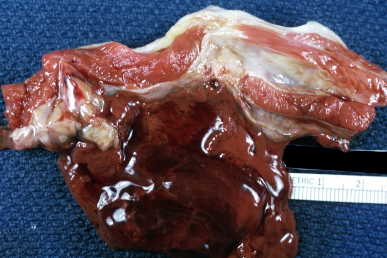 Skeletal muscle: Hematoma: Gross natural color flank muscle hematoma old showing typical chocolate appearance of blood coagulum young female with lupus and thrombocytopenia