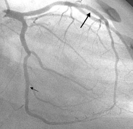 A teenager with MCTD presented as ACS post PCI