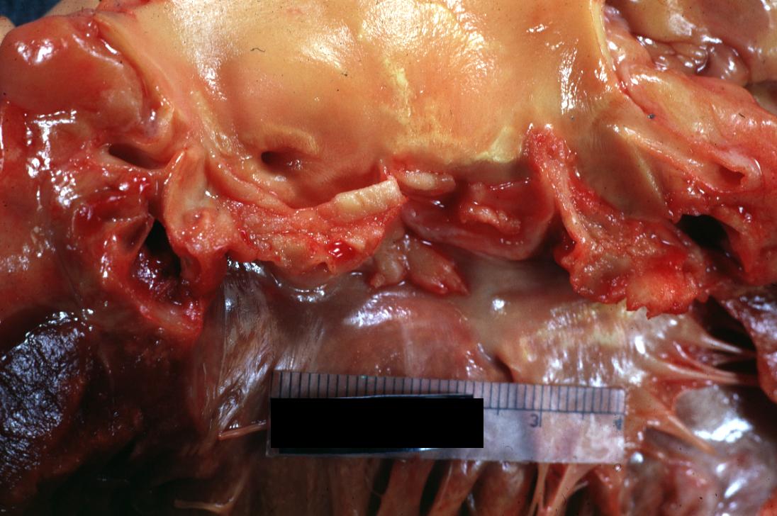 Thrombotic Nonbacterial Endocarditis: (Gross) An excellent example of thrombi on aortic valve.