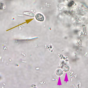 Cryptosporidium spp. oocysts (pink arrows) in wet mount. A budding yeast (brown arrow) is in the same field. Adapted from CDC