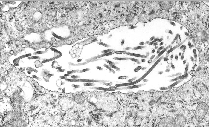 This transmission electron micrograph (TEM) demonstrates the ultrastructural morphologic changes in this tissue sample isolate.Adapted from Public Health Image Library (PHIL), Centers for Disease Control and Prevention.[7]