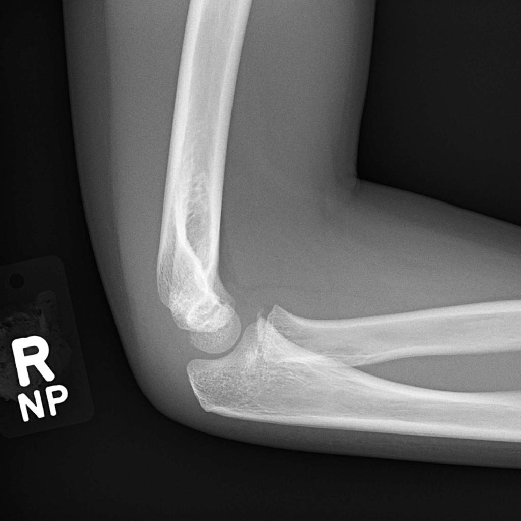 File:Lateral-condyle-fracture-3 (1).jpg