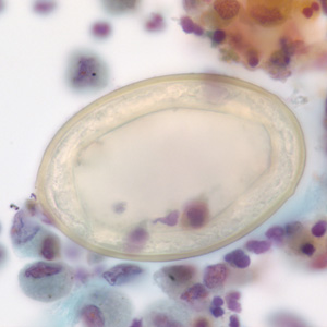 Higher magnification (1000x, oil) of the specimen in Figures 3 and 4. Image courtesy of Dr. Gary Procop. Adapted from CDC