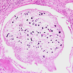 Proliferating sparganum in groin tissue of a patient from Paraguay, stained with hematoxylin and eosin (H&E). Adapted from CDC