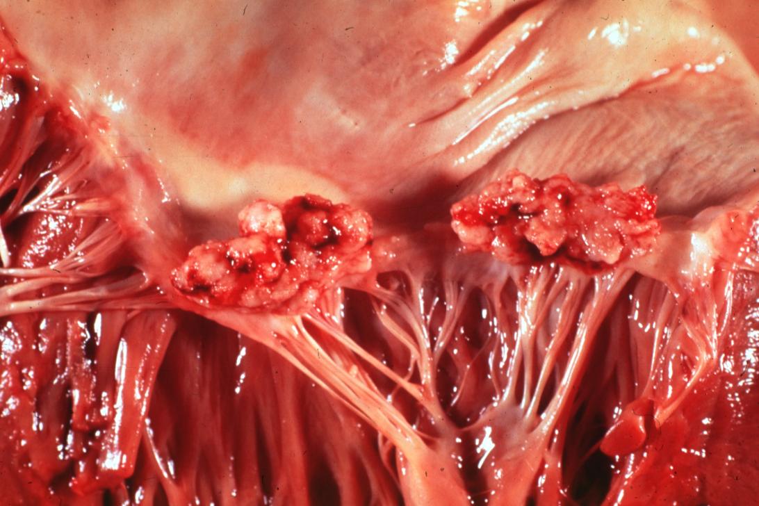 Bacterial Endocarditis: (Gross) An excellent close-up view of mitral valve vegetations