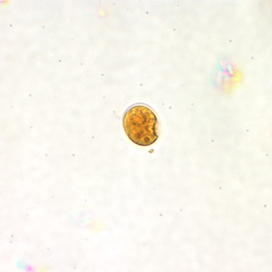 Cyst of E. nana in a direct wet mount stained with iodine. Adapted from CDC