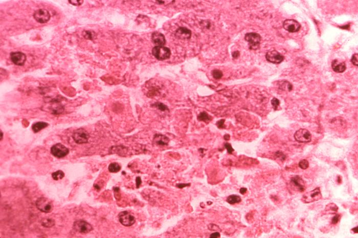 Scanning electron micrograph (SEM) demonstrates the cytoarchitectural changes of a liver tissue specimen extracted from a patient with Lassa fever. A zone of acidophilic necrosis, and numbers of pycnotic nuclei are noted.Retrieved from the Public Health Image Library (PHIL), Centers for Disease Control and Prevention.[10]