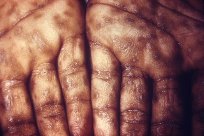 These are secondary syphilitic lesions, known as syphilids on a patient's palms. The second stage starts when one or more areas of the skin break into a rash that appears as rough, red or reddish brown spots both on the palms of the hands and on the bottoms of the feet. Even without treatment, rashes clear up on their own. Adapted from CDC