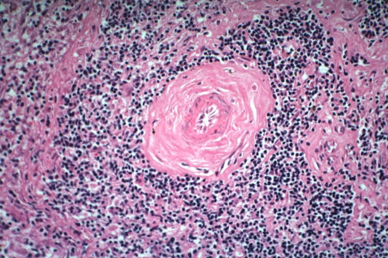 Spleen: Lupus erythematosus Periarterial Fibrosis: Micro high may H&E. An excellent example of periarterial fibrosis