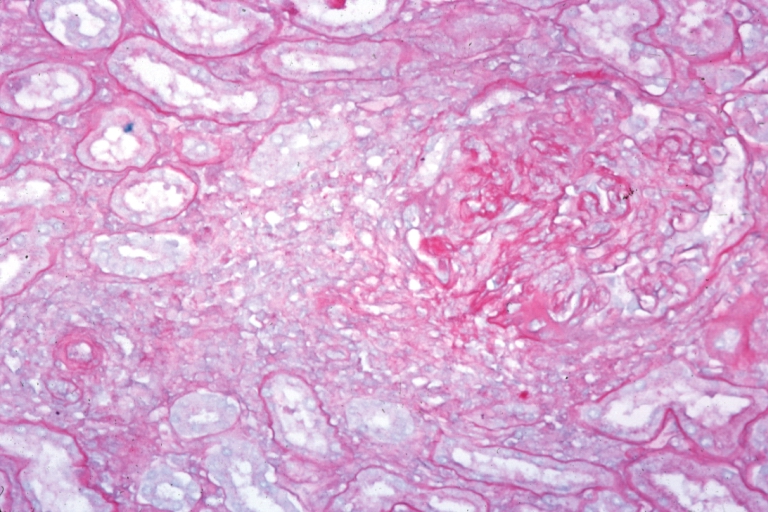 Kidney: Lupus Erythematosus: Micro med mag PASH glomerulonephritis