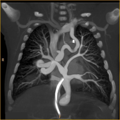 File:Total-anomalous-pulmonary-venous-return-type-iv.jpg