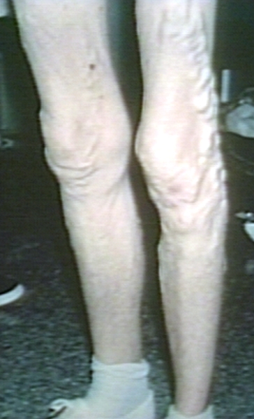 Varicose veins (Image courtesy of Charlie Goldberg, M.D., UCSD School of Medicine and VA Medical Center, San Diego, CA)