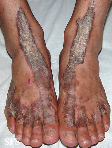 Inflammatory linear verrucous naevi-bilateral. Adapted from Dermatology Atlas.[3]