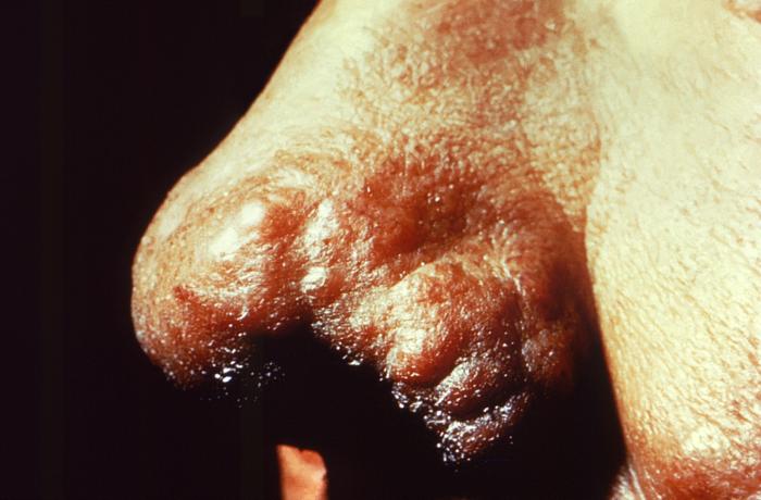 Cutaneous changes of lepromatous leprosy. Note reddish-brown nodules atop the left ala. Adapted from Public Health Image Library (PHIL), Centers for Disease Control and Prevention.[6]