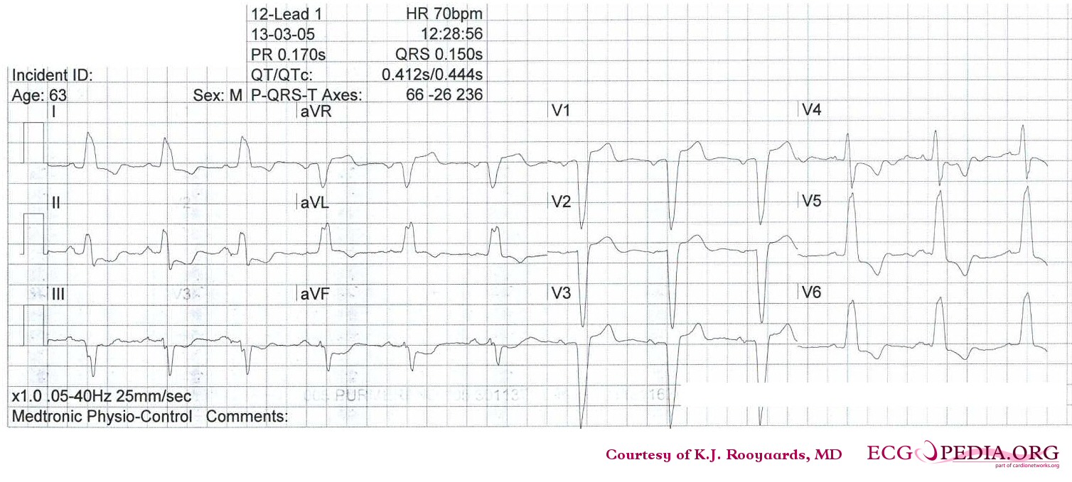 Sinus rhythm with left bundle branch block, comparison with an old EKG is mandatory to evaluate whether the LBBB is new (a sign of myocardial infarction) or old.