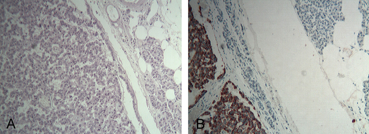 Histopathological examination of the pancreatic tumor.A) The tumor appears encapsulated and composed of polygonal cells with trabecular or ribbon-like proliferation (HE 5 X). B) At immunohistochemistry, neoplastic cells showed an intense diffuse staining for glucagon (Anti-glucagon antibody 5 X)[11]