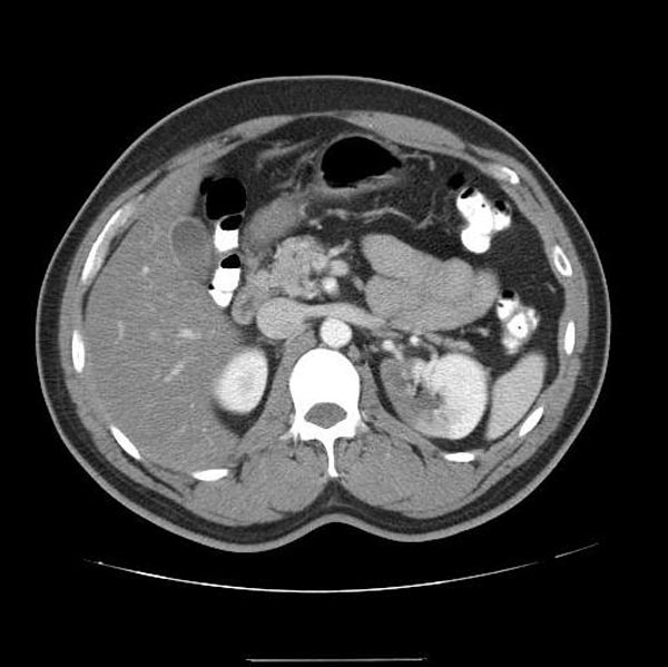 CT demonstrates a left renal infarction patient#1 Image courtesy of RadsWiki and copylefted