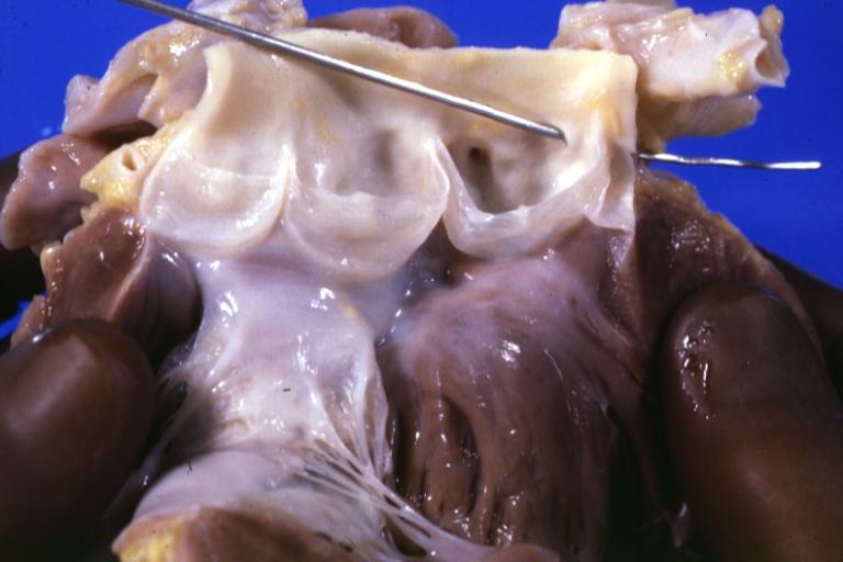 Gross left coronary artery originates from right sinus of Valsalva sudden unexpected death