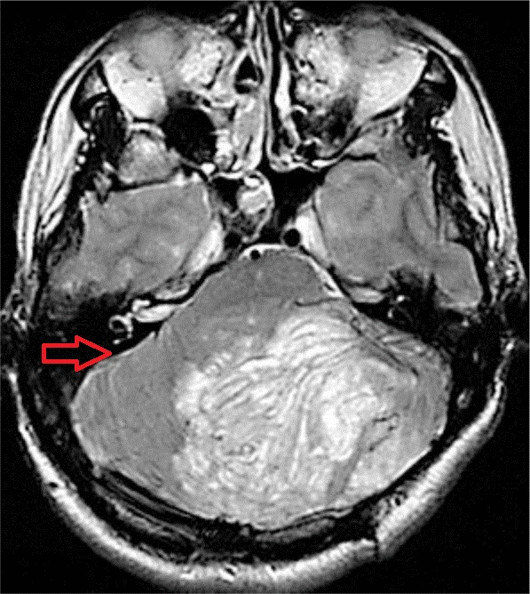 Cerebellar Mass in Lhermitte-Duclos Disease