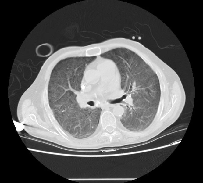 File:Metastatic pulmonary calcification 103.jpg
