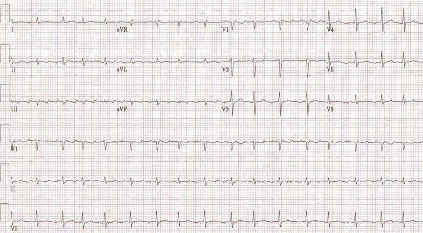 Atrial flutter with variable conduction