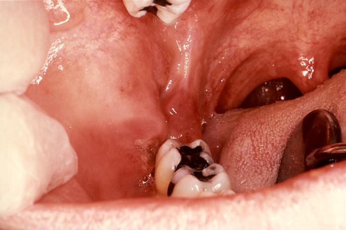 Kaposi’s sarcoma in the retromandibular region. From Public Health Image Library (PHIL). [3]