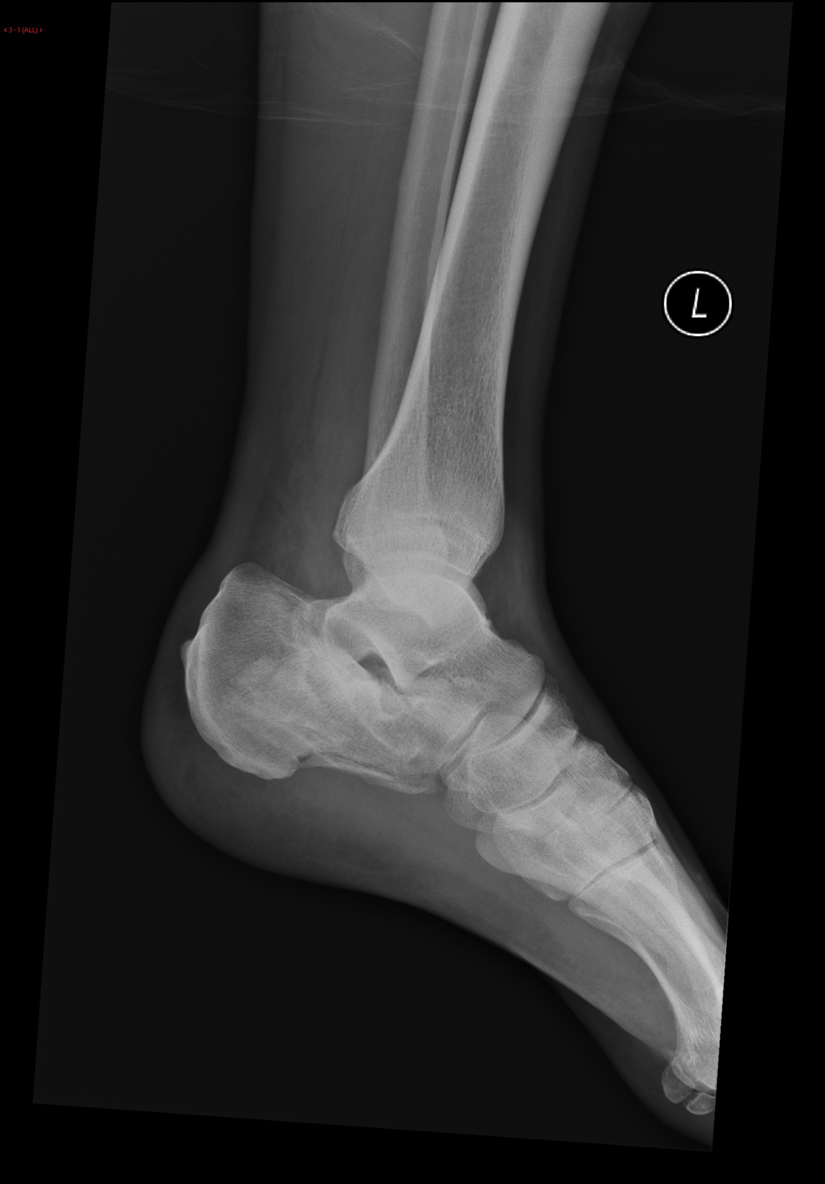 File:Calcaneal-fracture-and-associated-spinal-injury (1).jpg