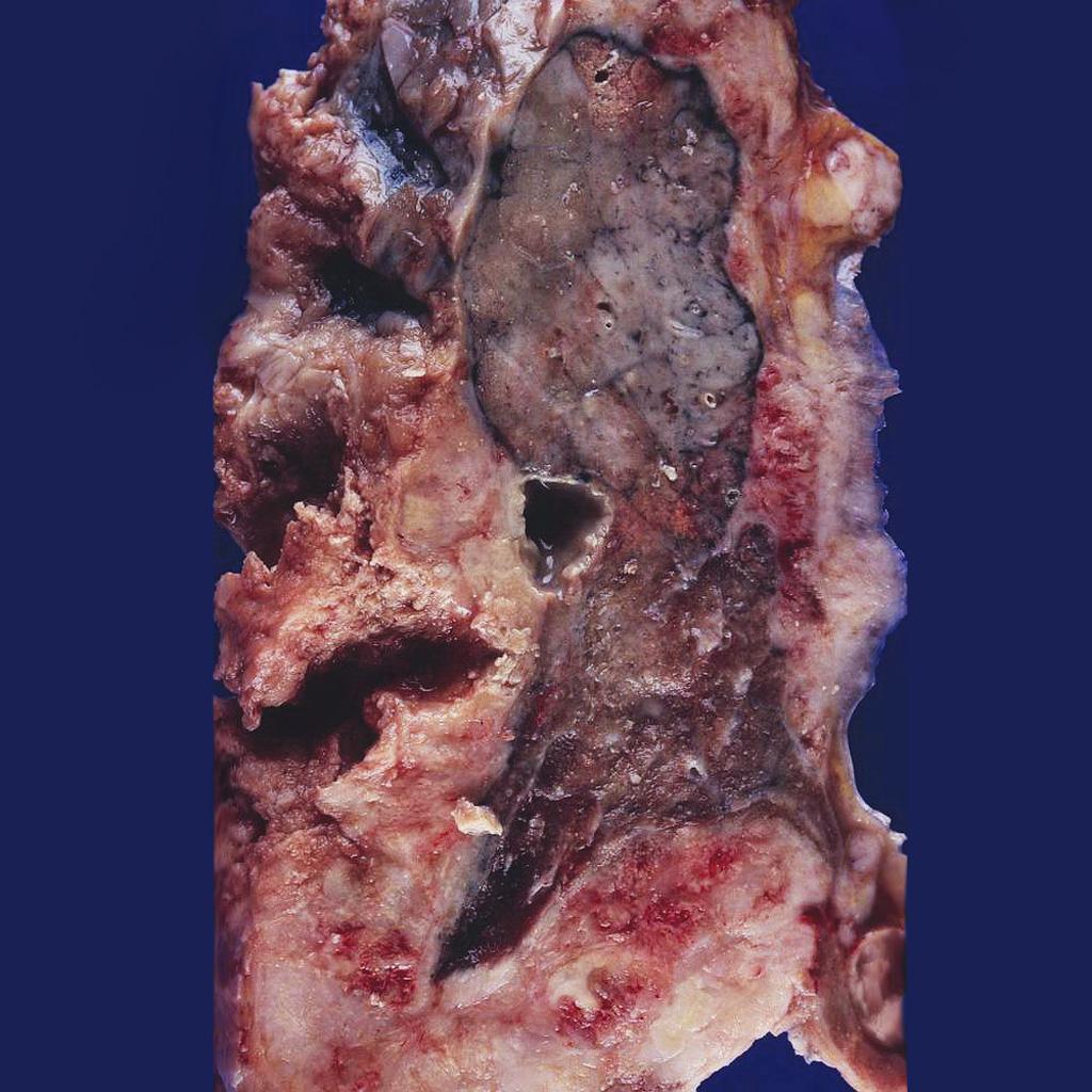 Mesothelioma completely encasing the lung.<ref name=grosspictureofmesotheliomaimage1>Image courtesy of Dr. Yale Rosen. Radiopaedia (original file here). Creative Commons BY-SA-NC