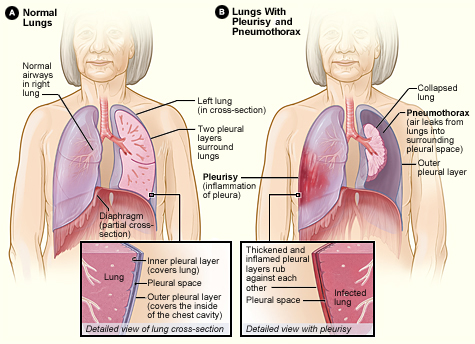 File:Pleurisy and pneumothorax.jpg