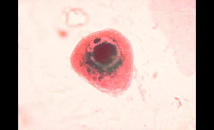 Cytomegalovirus infection of cell in urine. From Public Health Image Library (PHIL). [1]