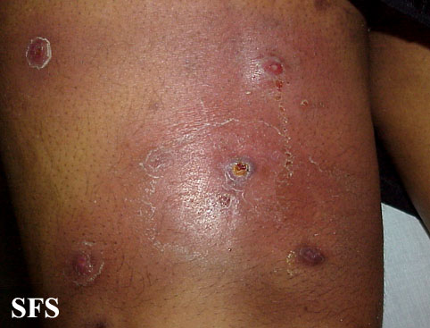 Boil. With permission from Dermatology Atlas.[2]